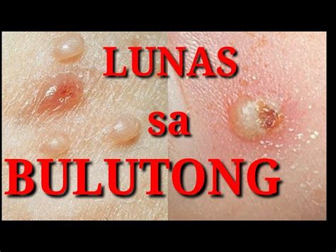 bulutong tubig picture|Bulutong Tubig: Alamin ang Lunas .
